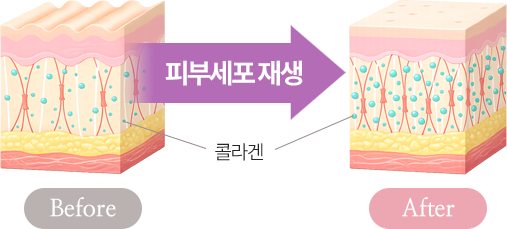 피부세포 재생(콜라겐)