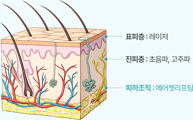 표피층 : 레이저 | 진피층 : 초음파, 고주파 | 피하조직 : 에어젯리프팅