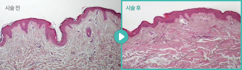 시술 전 | 시술 후