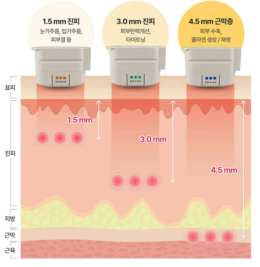 1.5 mm 진피 - 눈가주름, 입가주름, 피부결 등 | 3.0 mm 진피 - 피부탄력개선, 타이트닝 | 4.5mm 근막층 - 피부 수축, 콜라겐 생성 / 재생
