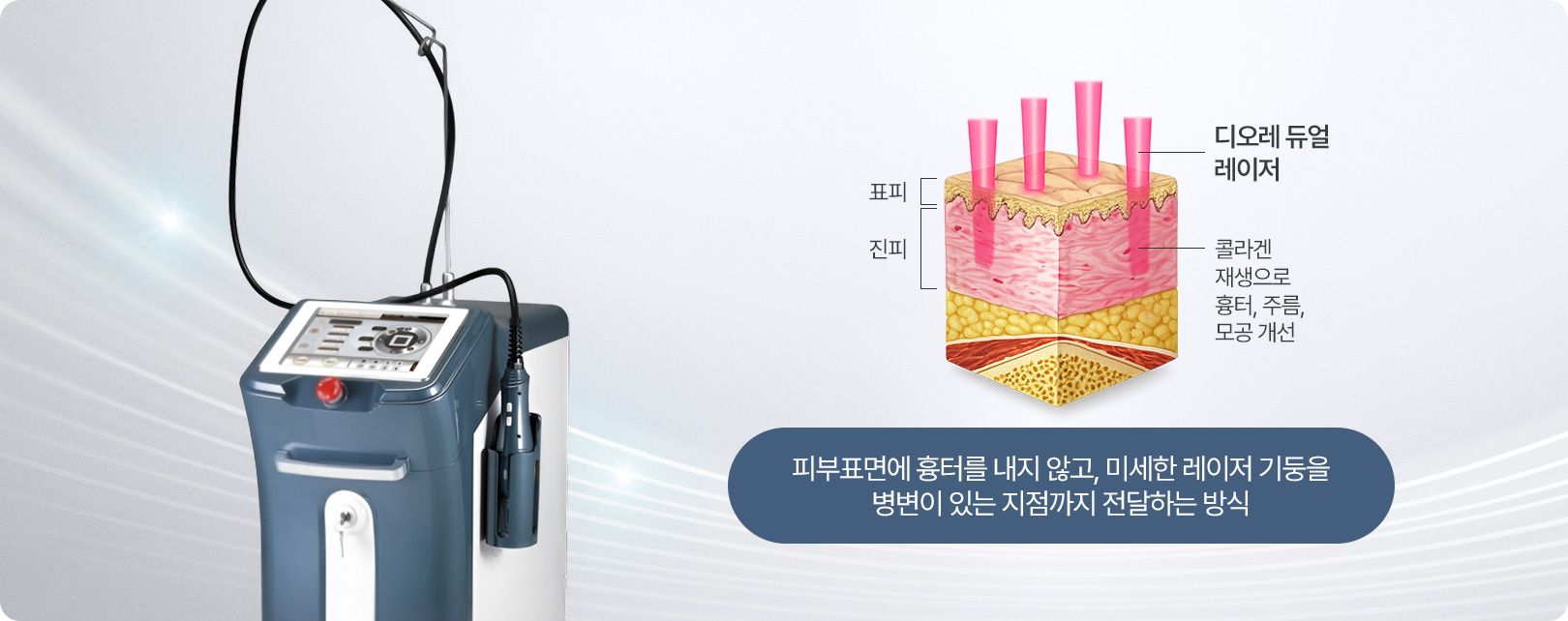 피부표면에 흉터를 내지 않고, 미세한 레이저 기둥을 병변이 있는 지점까지 전달하는 방식
