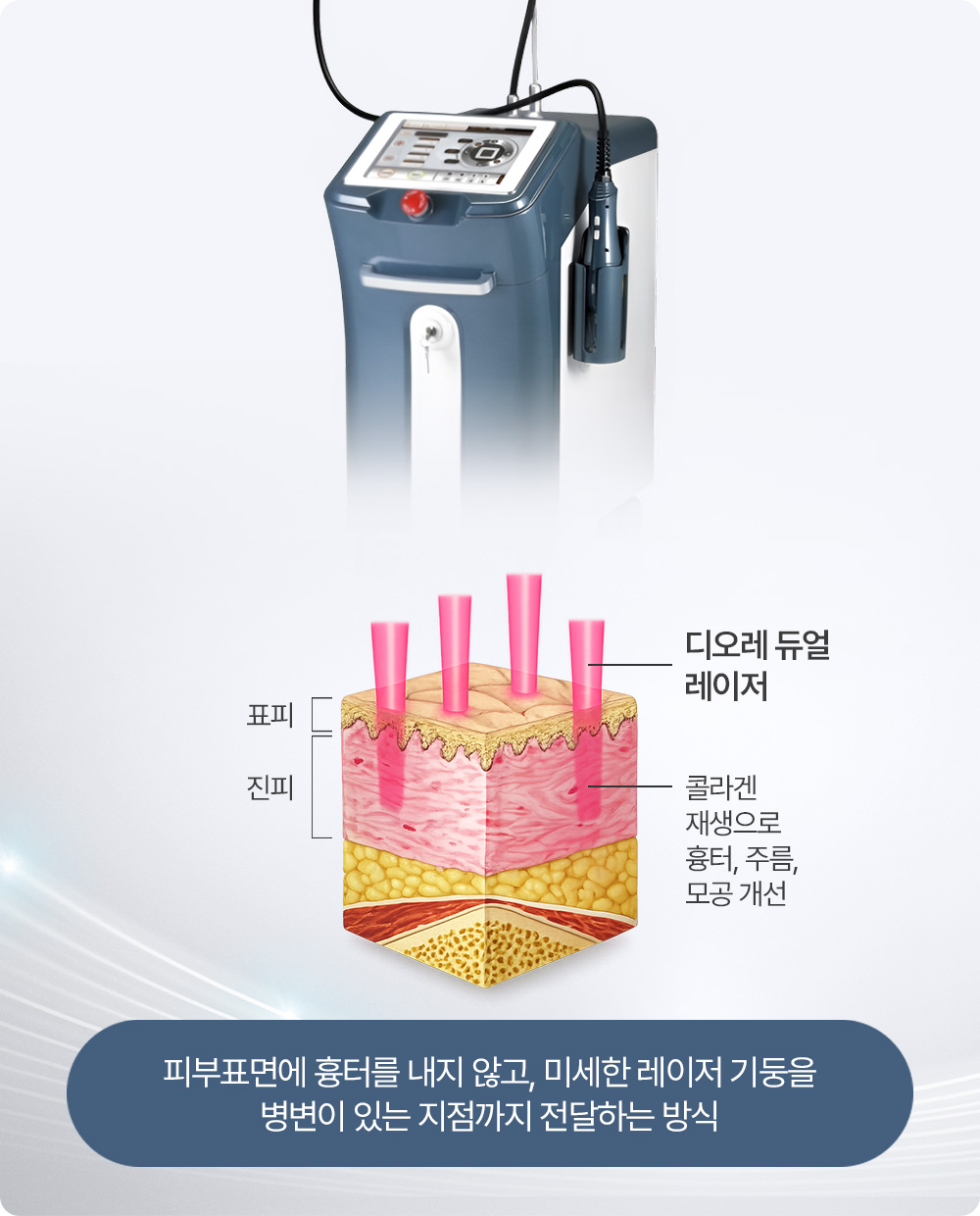 피부표면에 흉터를 내지 않고, 미세한 레이저 기둥을 병변이 있는 지점까지 전달하는 방식