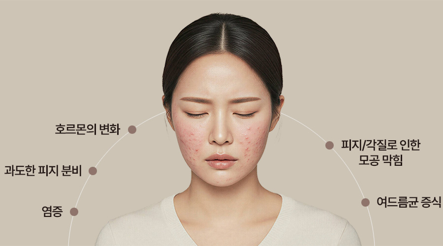 호르몬의 변화 | 과도한 피지 분비 | 염증 | 피지/각질로 인한 모공 막힘 | 여드름균 증식