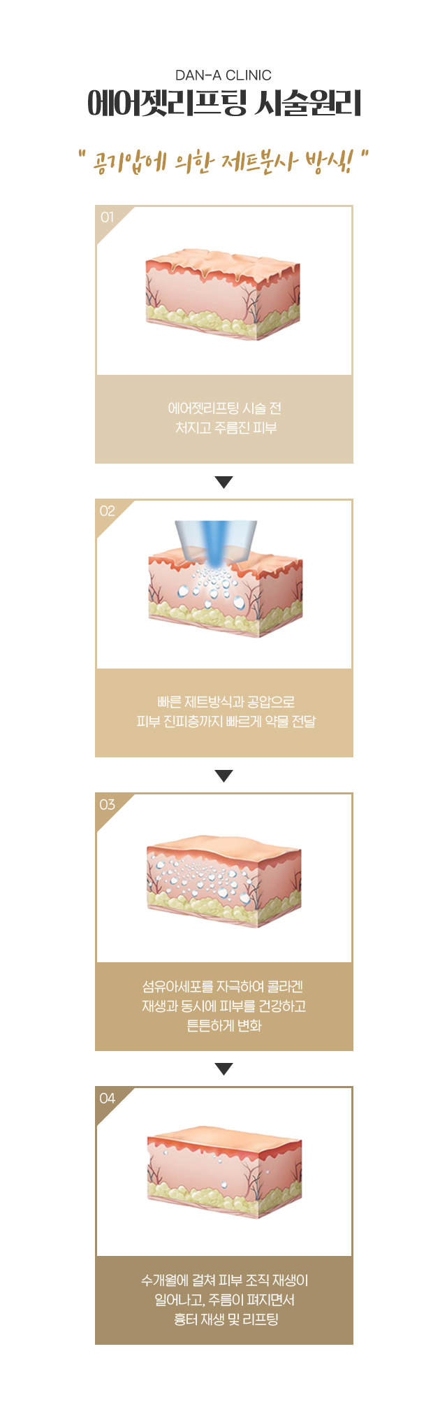 시술원리